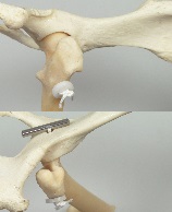 HIP TOGGLE 2,5MM + LIGAFIBA 250LB + KNOOP ORMROD TI >10KG VI-HIPTOGLF250MTI